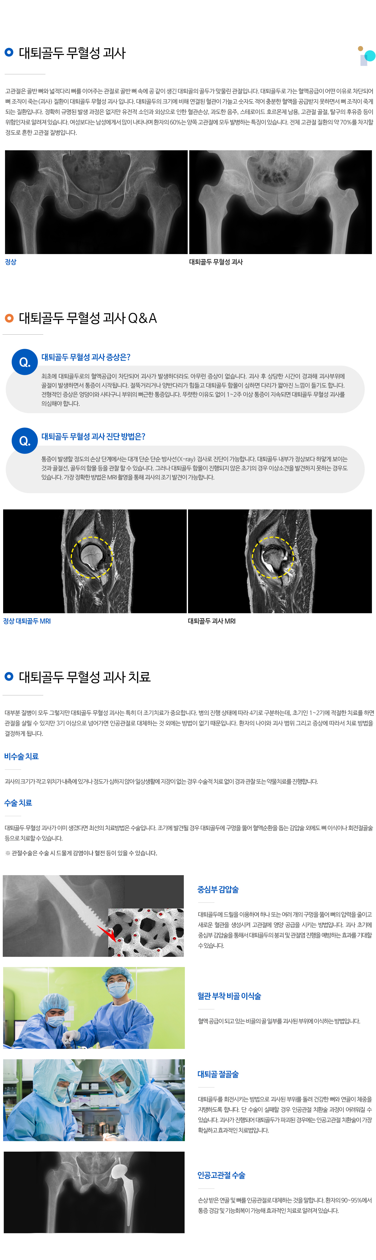 대퇴골두 무혈성 괴사