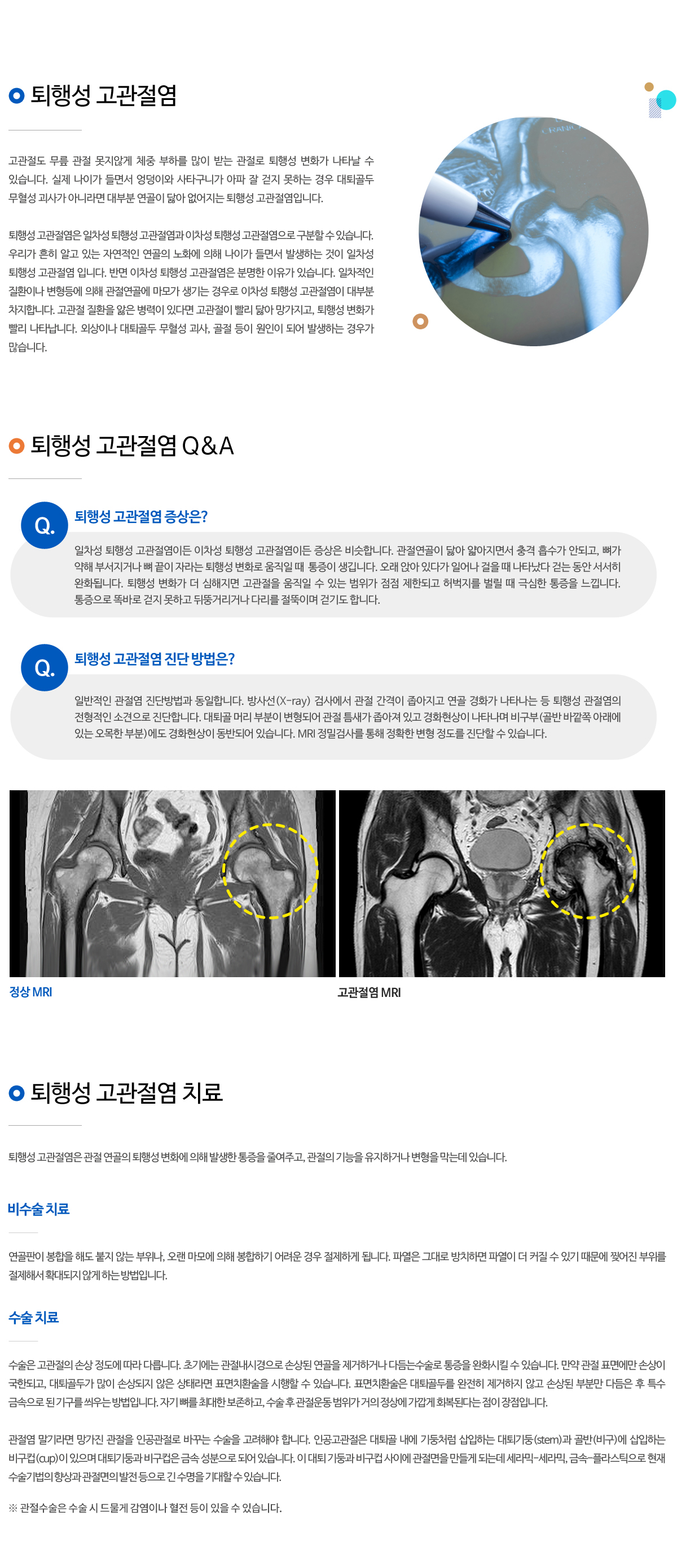 퇴행성 고관절염