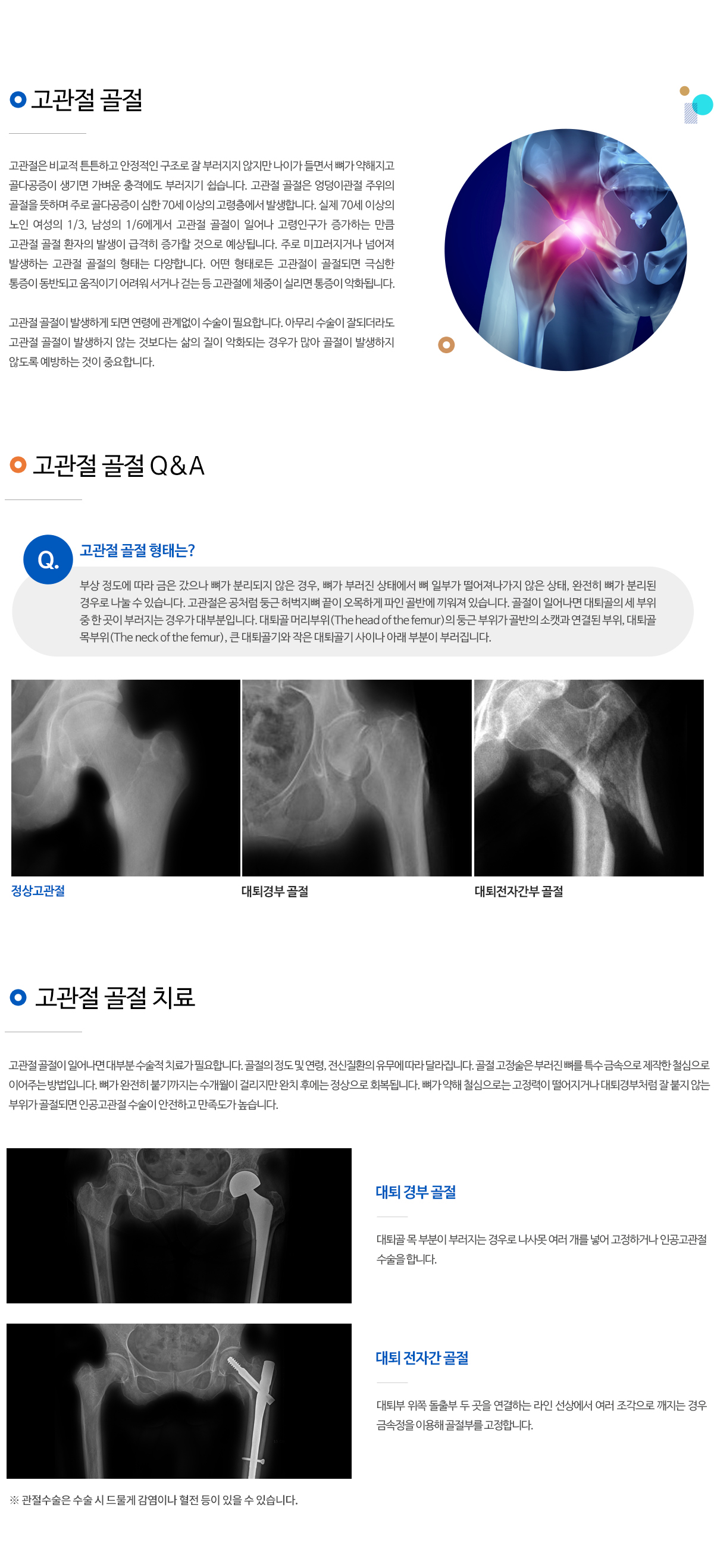 고관절 골절