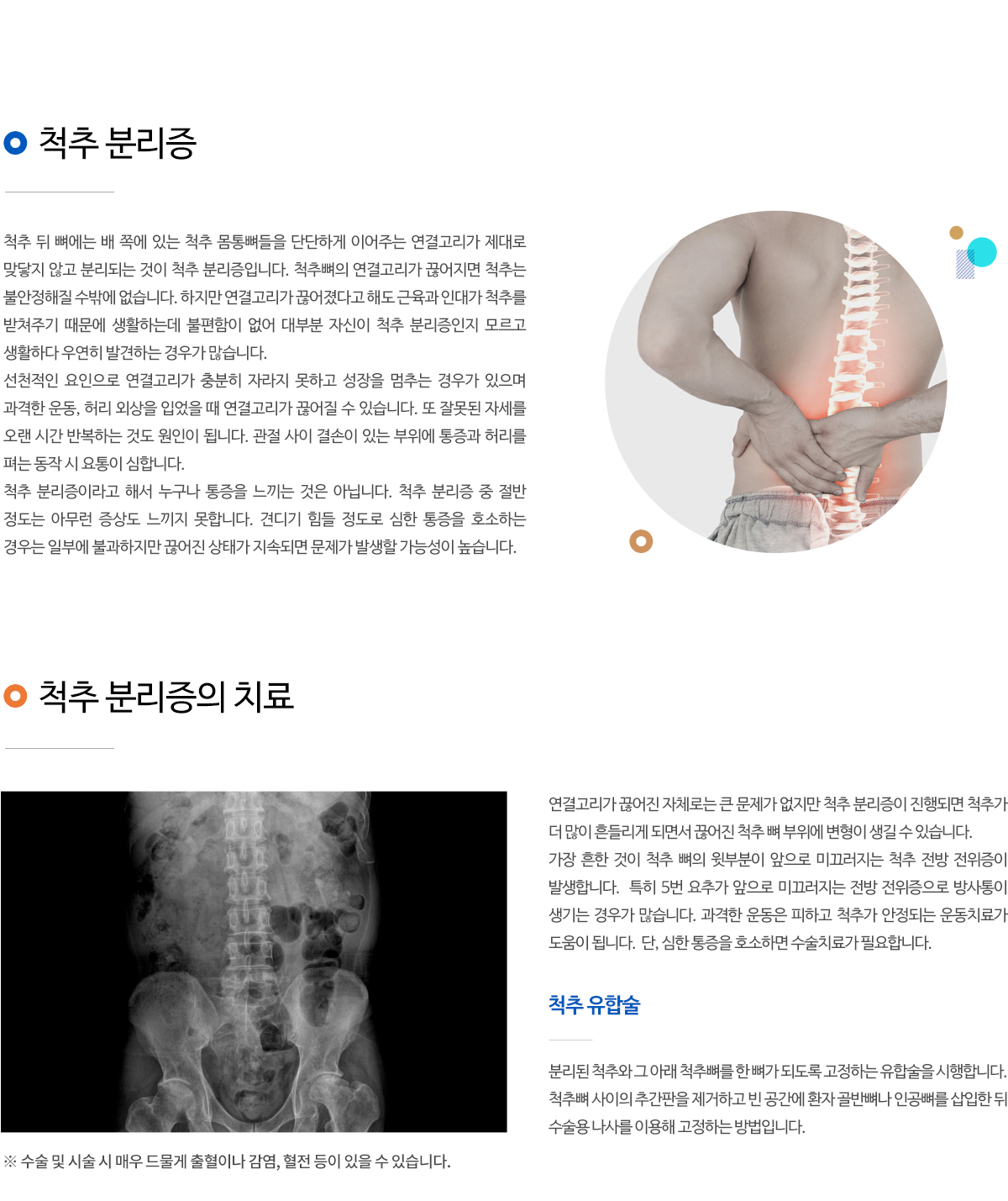 척추분리증