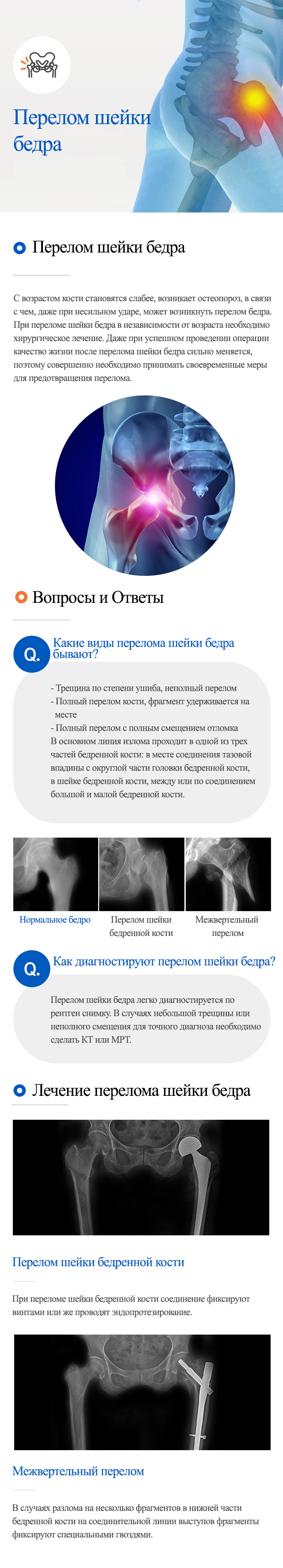 Hip fracture